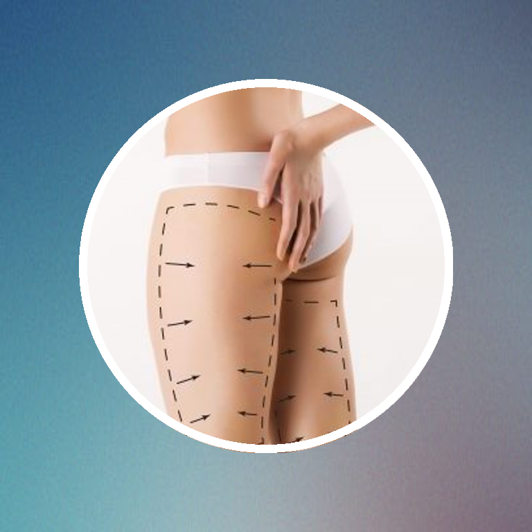 Liposucció